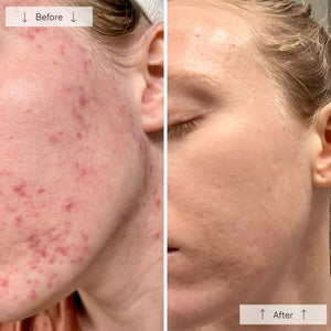 The OMNILUX - CLEAR MASK is a white and teal LED light therapy mask for acne with eye, nose, and mouth cutouts. It emits a pink glow and has two side adjustable straps. Dermatologist-recommended, it sits against a plain background.