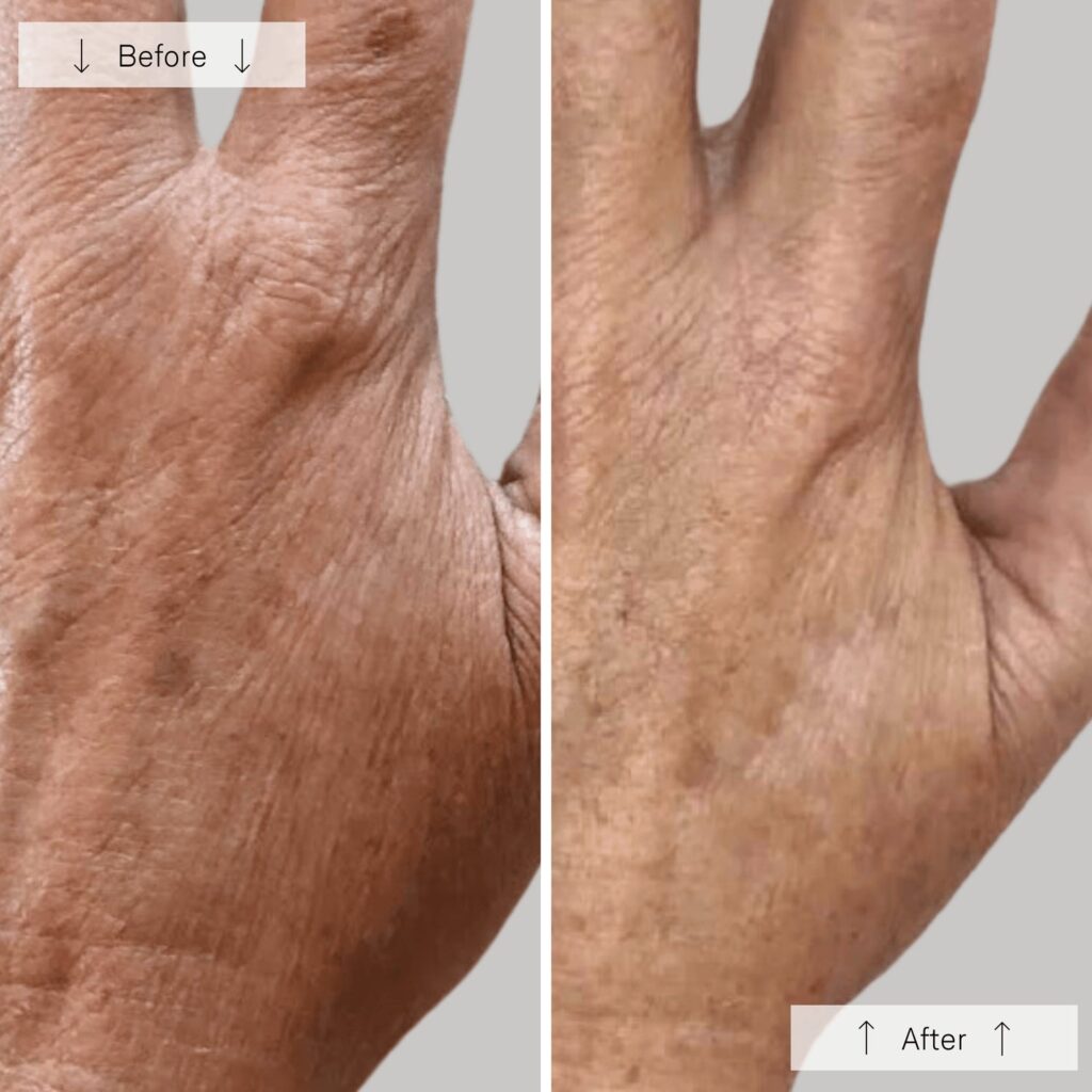 Side-by-side comparison of a hand labeled "Before" (left) showing more visible dark spots and rough texture, and "After" (right) with smoother skin and reduced discoloration. Fearrington Village