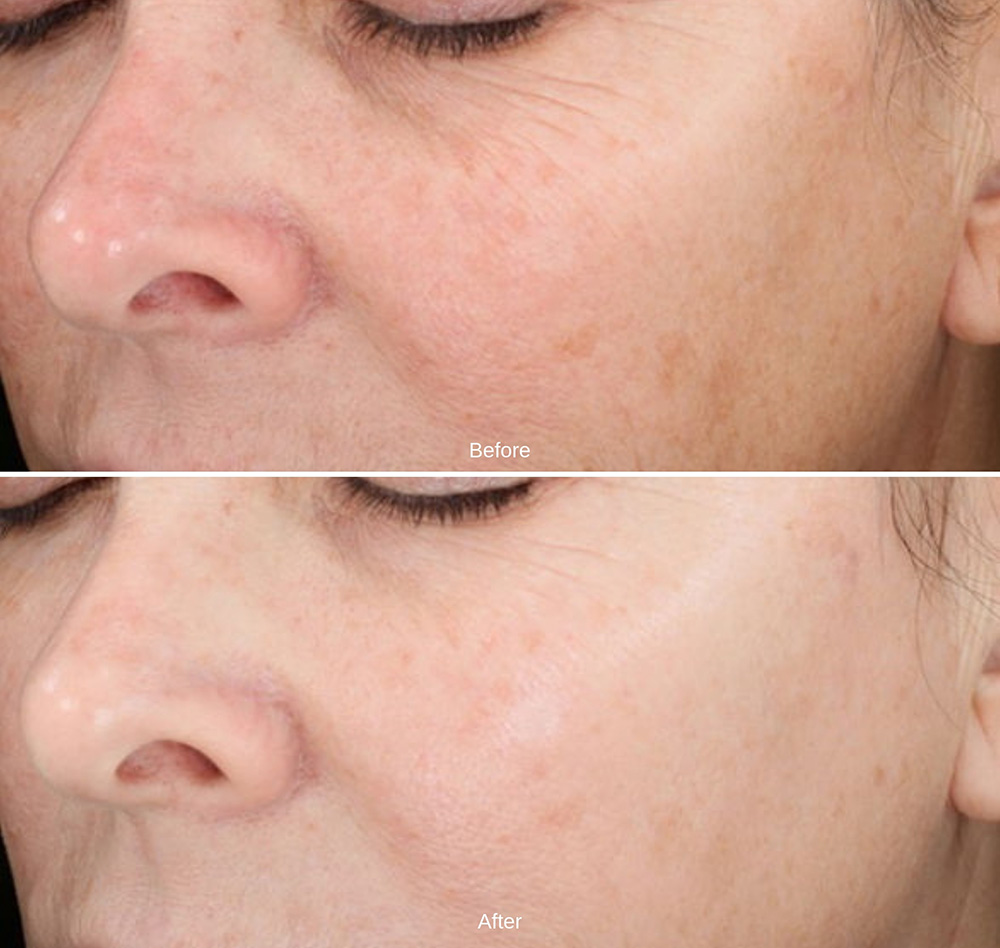 Side-by-side close-up of a woman's face, showing "before" with visible wrinkles and uneven skin tone, and "after" with smoother, brighter, and more even skin. Fearrington Village